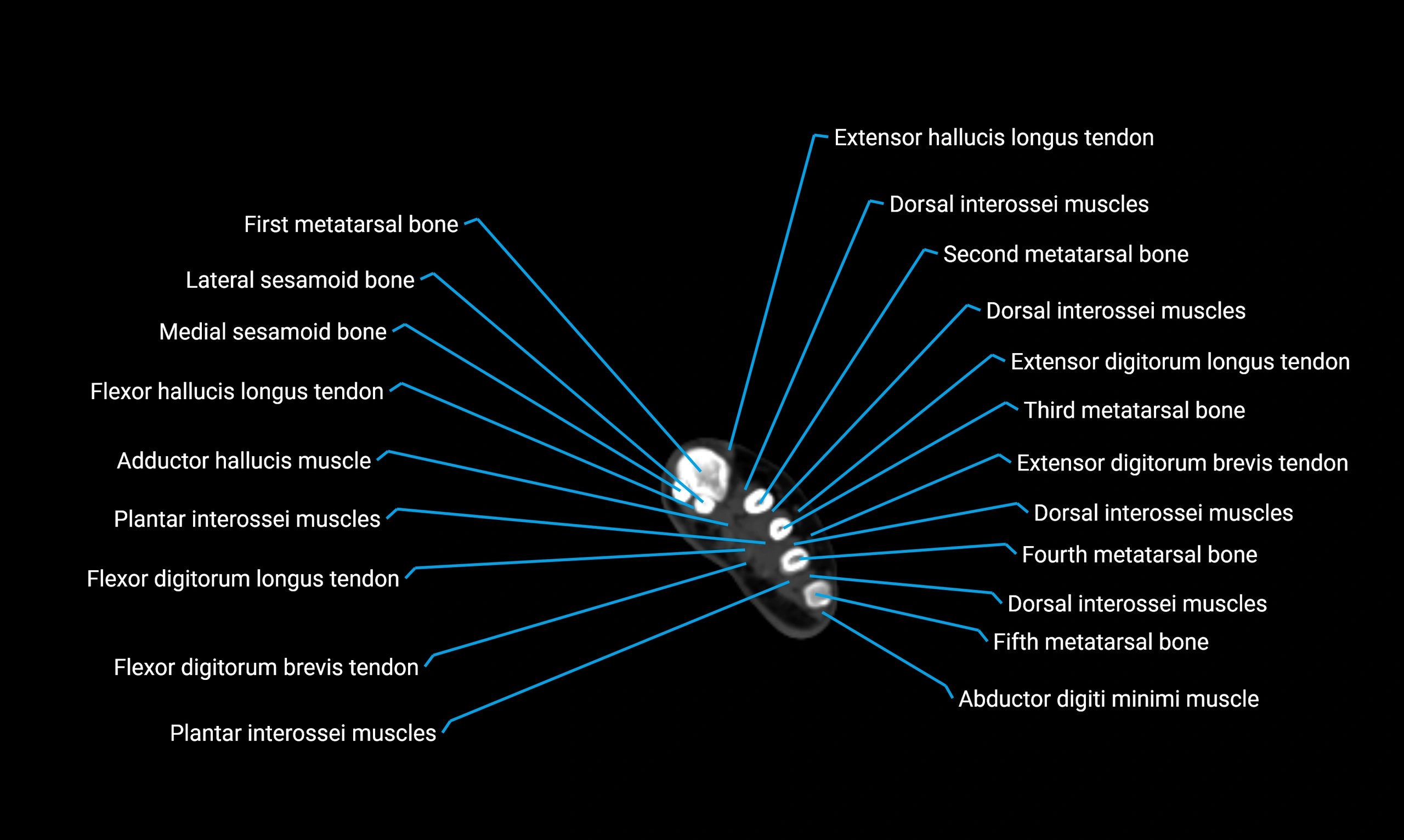 CT lower limb axial cross sectional anatomy labelled image 191 (2).webp